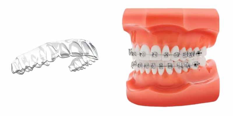 A comparaison photo between the clear aligners and Braces.