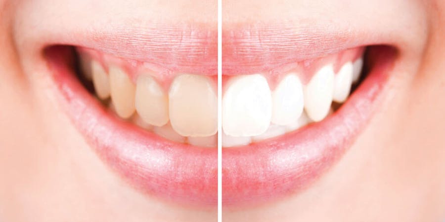 Teeth Whitening Burlington